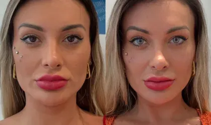 Antes e depois de Andressa Urach  • Instagram/Andressa Urach